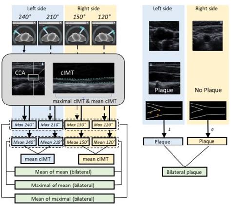 cimt vs carotid ultrasound